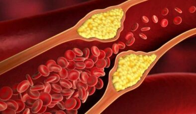 Kolesterol Hastaları Nasıl Beslenmelidir?