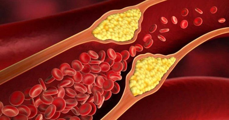 Kolesterol Hastaları Nasıl Beslenmelidir?